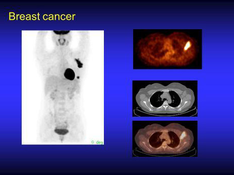 PET 건강진단에서 우연히 발견한 유방암. 왼쪽 전신 영상에서 심장(정상으로 보임) 옆에 유방암이 보이고 같은 쪽 겨드랑이 림프절에 유방암이 전이된 것이 보임.  /포항세명기독병원 제공