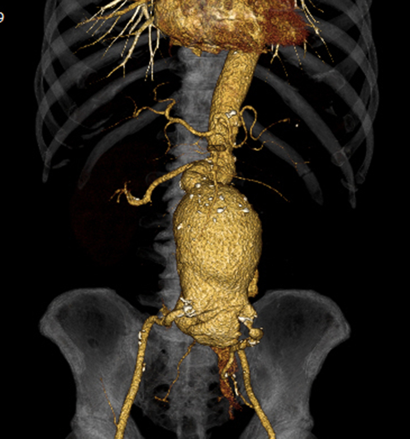 수술 전 복부 CT에서 관찰되는 파열된 복부 대동맥류.