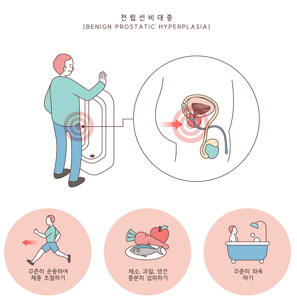 남자 잔뇨 전립선 운동 필수?